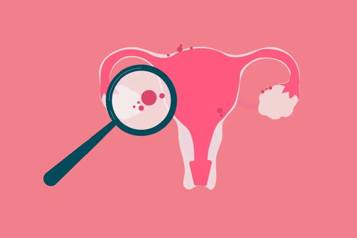 5 fatos pouco conhecidos sobre a endometriose