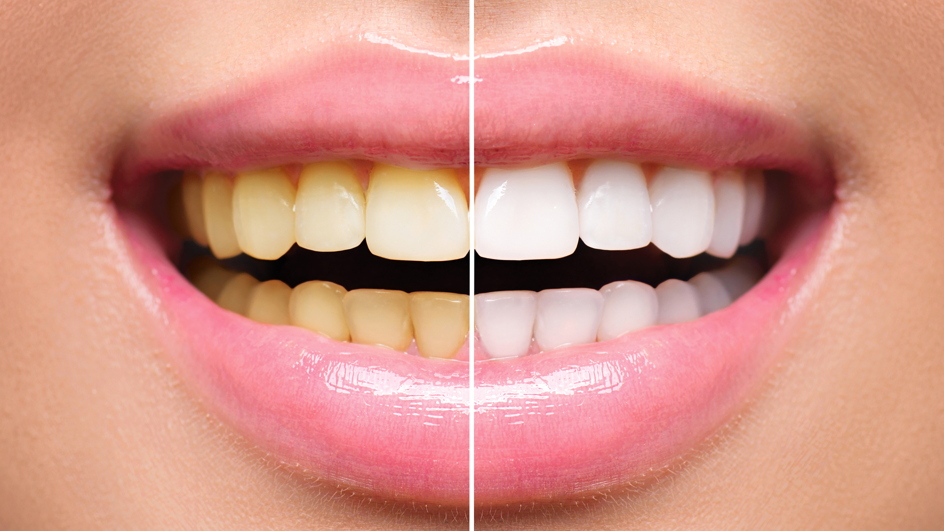 Conheça os diferentes tipos de aparelho dentário! - Sorridents